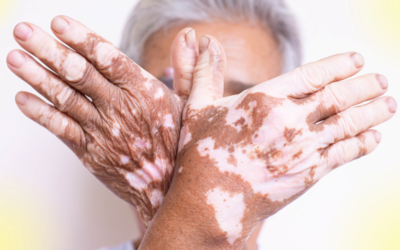 Vitiligo chez les aînés : comprendre les défis de cette maladie cutanée